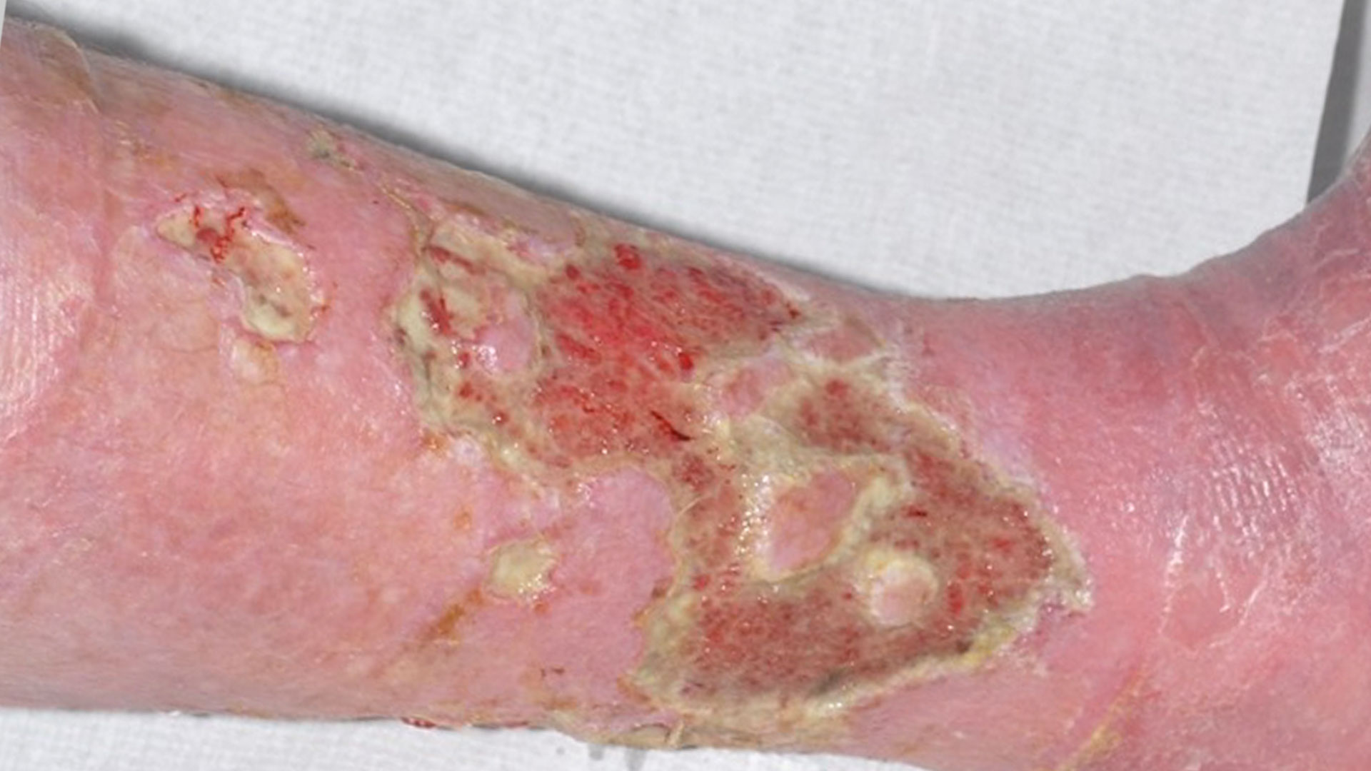 Leg ulcer